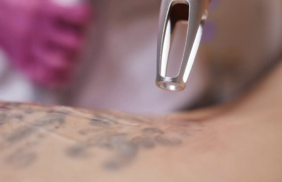 detatouage laser perpignan