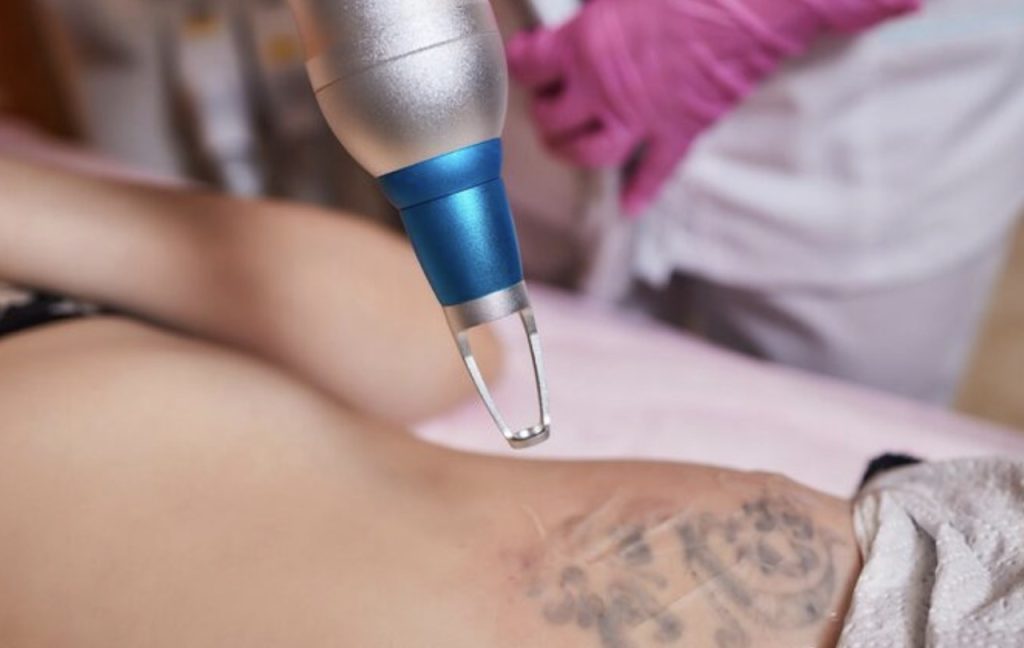 seance detatouage laser a perpignan